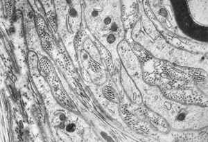 F,12y. | hypertrophic (onion bulb) neuropathy - n.suralis F,12y. | hypertrophic (onion bulb) neuropathy - n.suralis